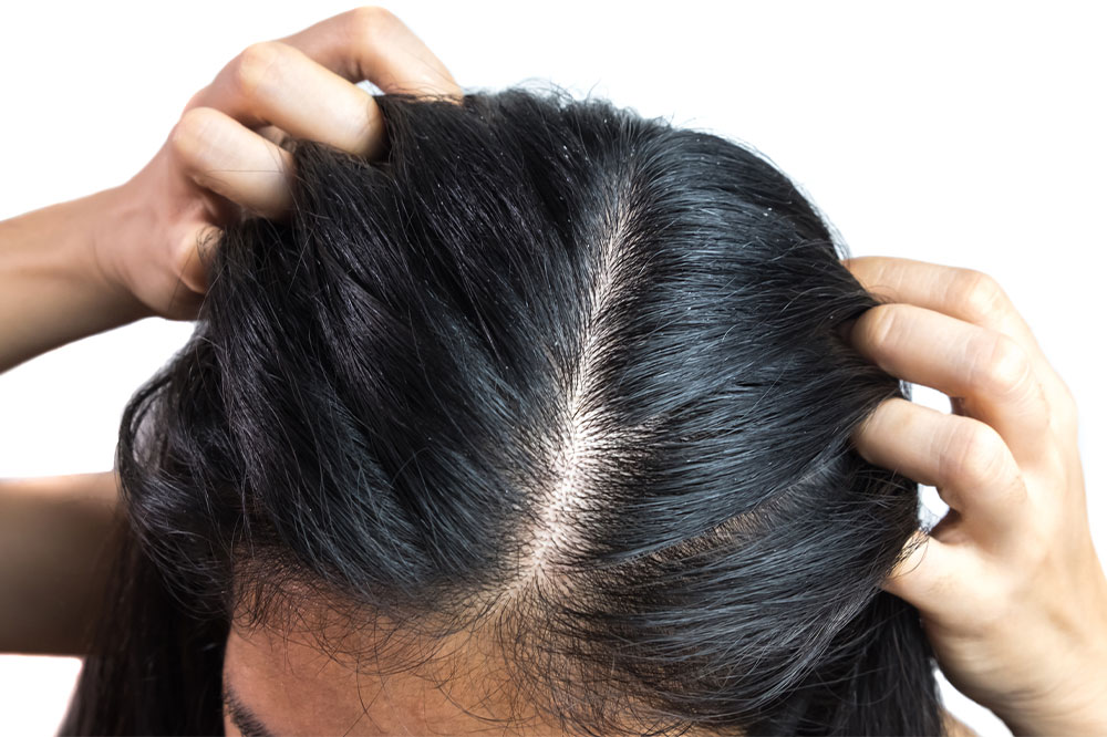 5 Hair Care Tips to Keep Dandruff at Bay