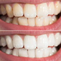 The Top Teeth Whitening Myths and Facts