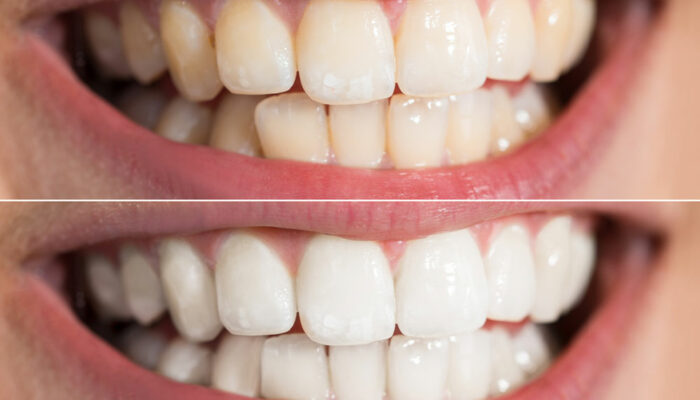 The Top Teeth Whitening Myths and Facts