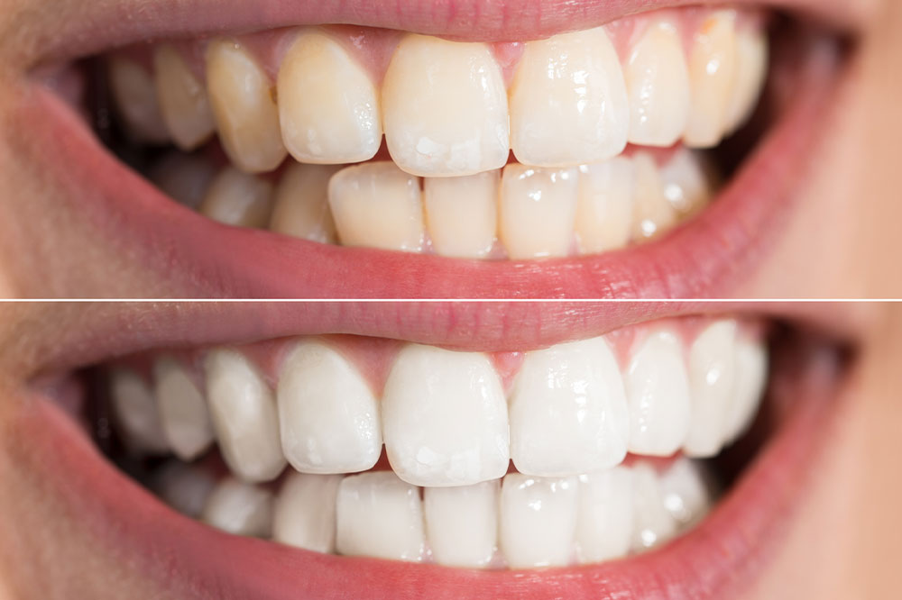 The Top Teeth Whitening Myths and Facts